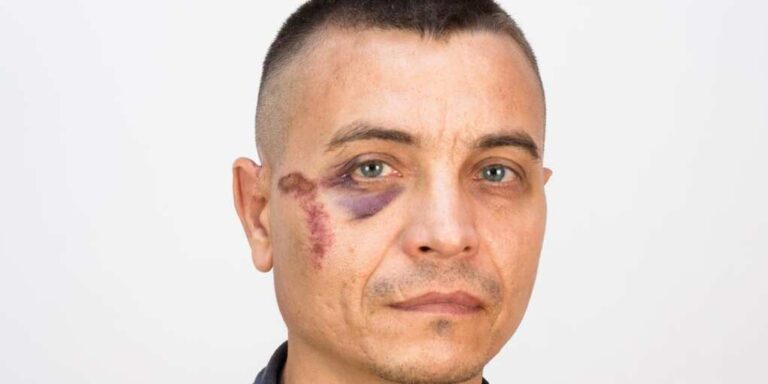 Elon Explains That Black Eye—and It’s Not What Anyone Expected